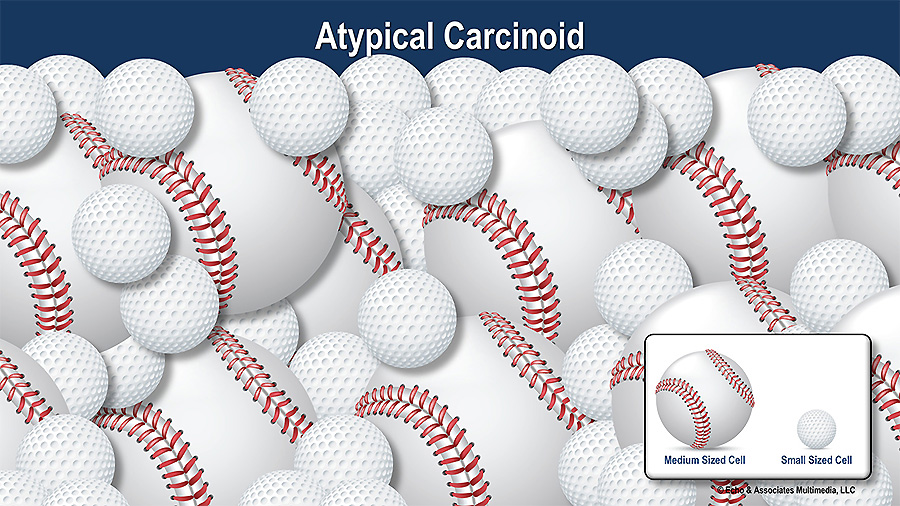 Atypical Carcinoid